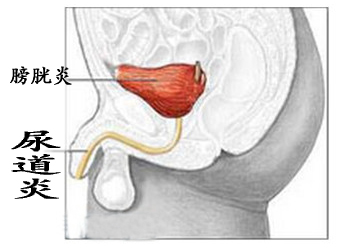 尿道炎給男性患者帶來哪些危害