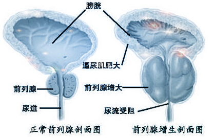 前列腺增生的危害有多大