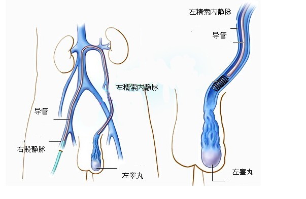 預(yù)防精索靜脈曲張的方法有哪些